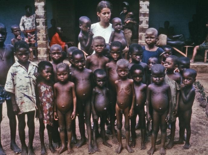 A group of children displaying symptoms of Kwashiorkor