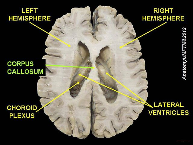 image of sliced brain showing corpus callosum