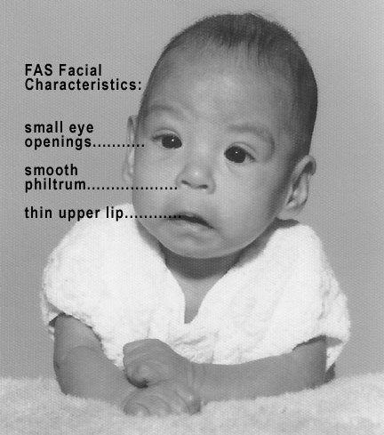 An infant with FAS with FAS characteristics shown