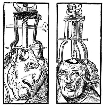 A 1525 engraving that shows trephination.