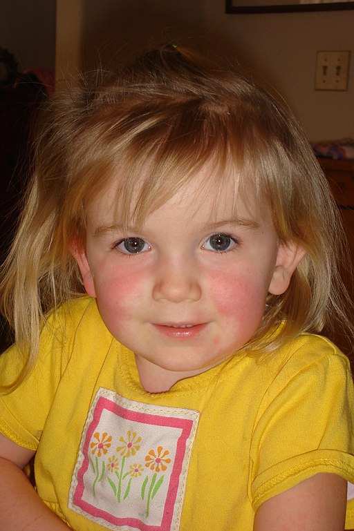 Scarlet fever rash