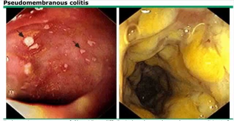 Pseudomembrane colitis