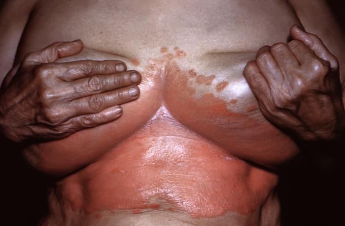 Cutaneous Candidiasis infection