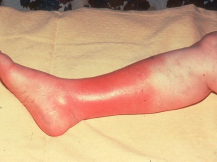 Cellulitis