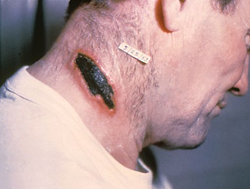 Cutaneous anthrax