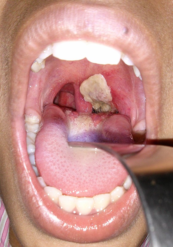 Pseudomembrane of diphtheria