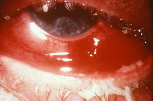 Gonorrhea of the eye