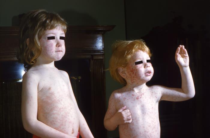 German measles rash