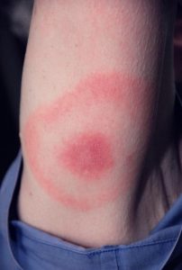 Lyme disease bulls eye rash