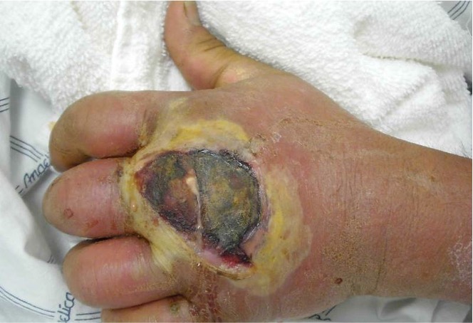 MRSA wound infection