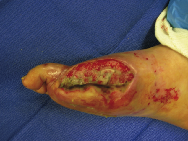 MRSA wound infection