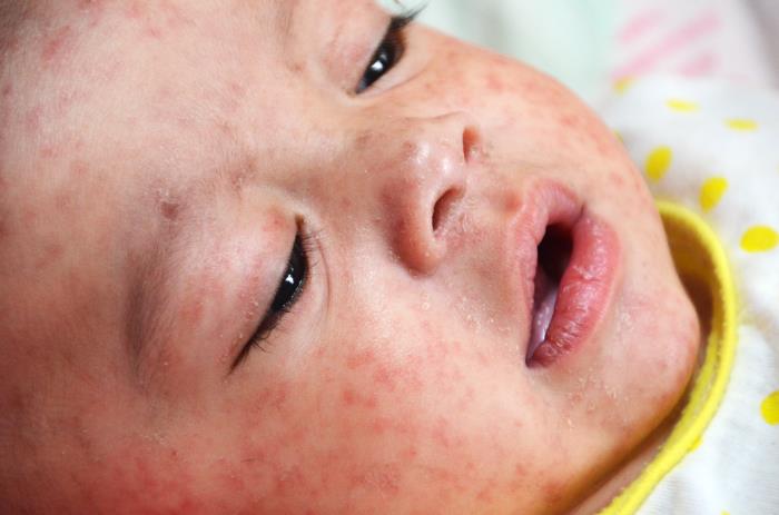 Measles rash