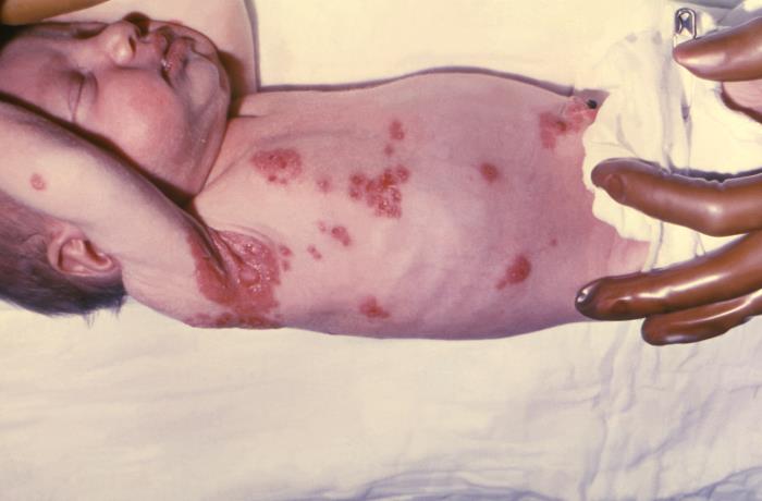 Neonatal herpes