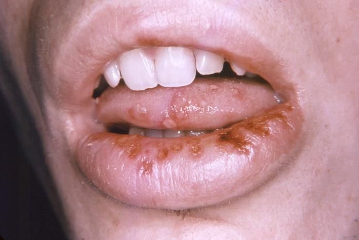 Oral herpes