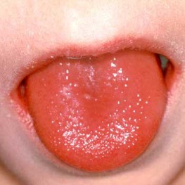 Scarlet fever tongue