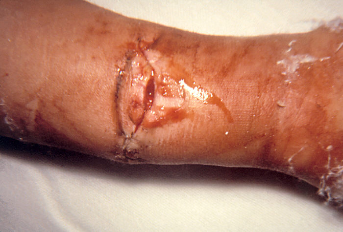 Wound botulism