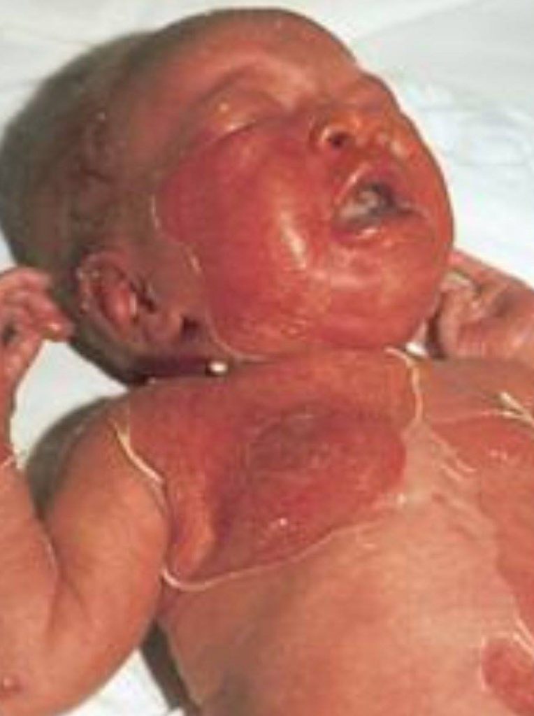 Scalded skin syndrome