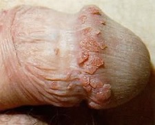 Warts