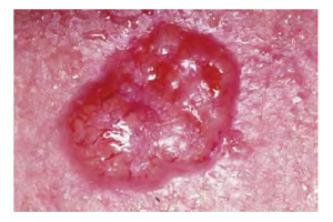 Image of basal cell carcinoma