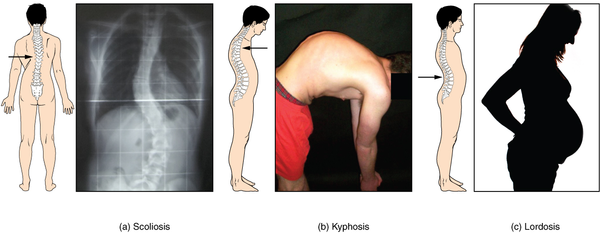 Abnormal curvature of the spinal column. Image description available.