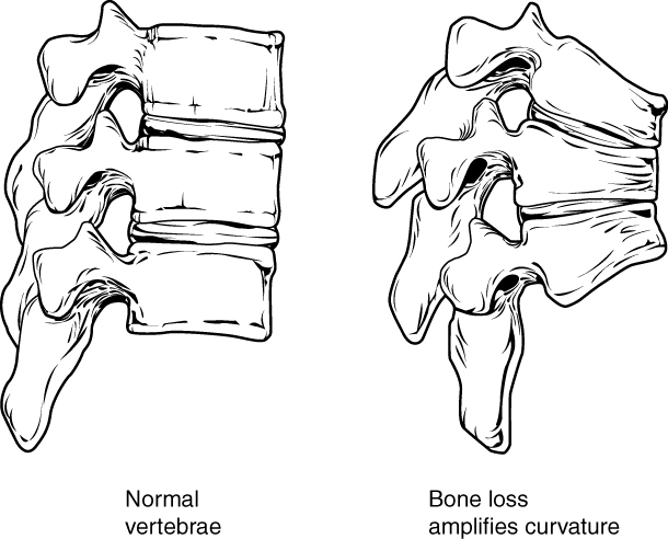 Changes to spine in osteoporosis. Image description available.