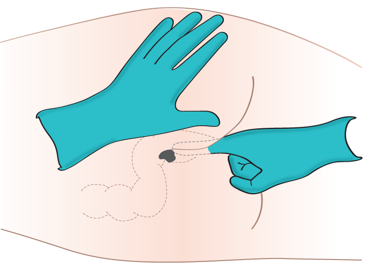 Illustration showing administration of a rectal suppository