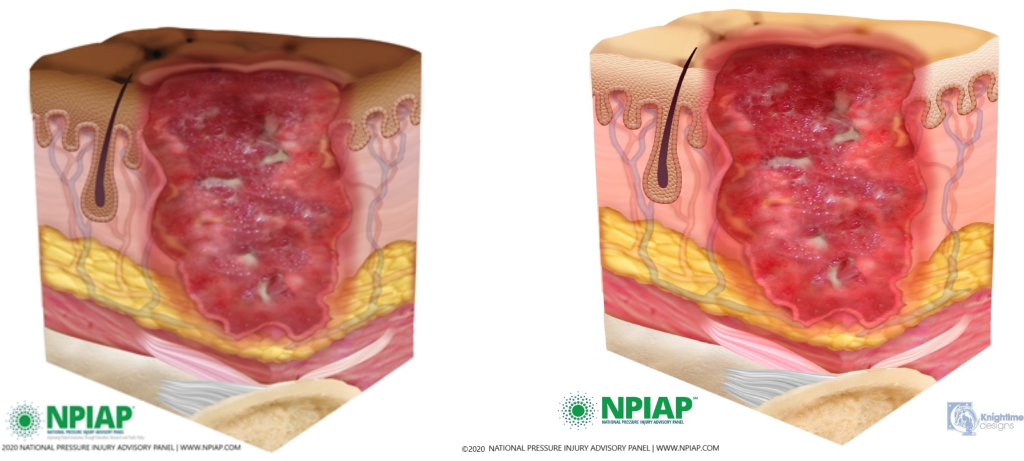 Image showing stage 3 pressure injury on both dark and light pigmented skin