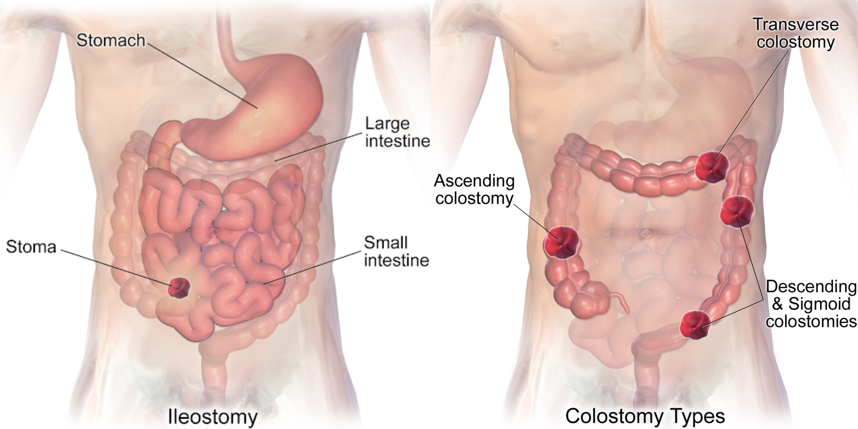 Illustration showing Location of an Ileostomy Compared to Colostomies 