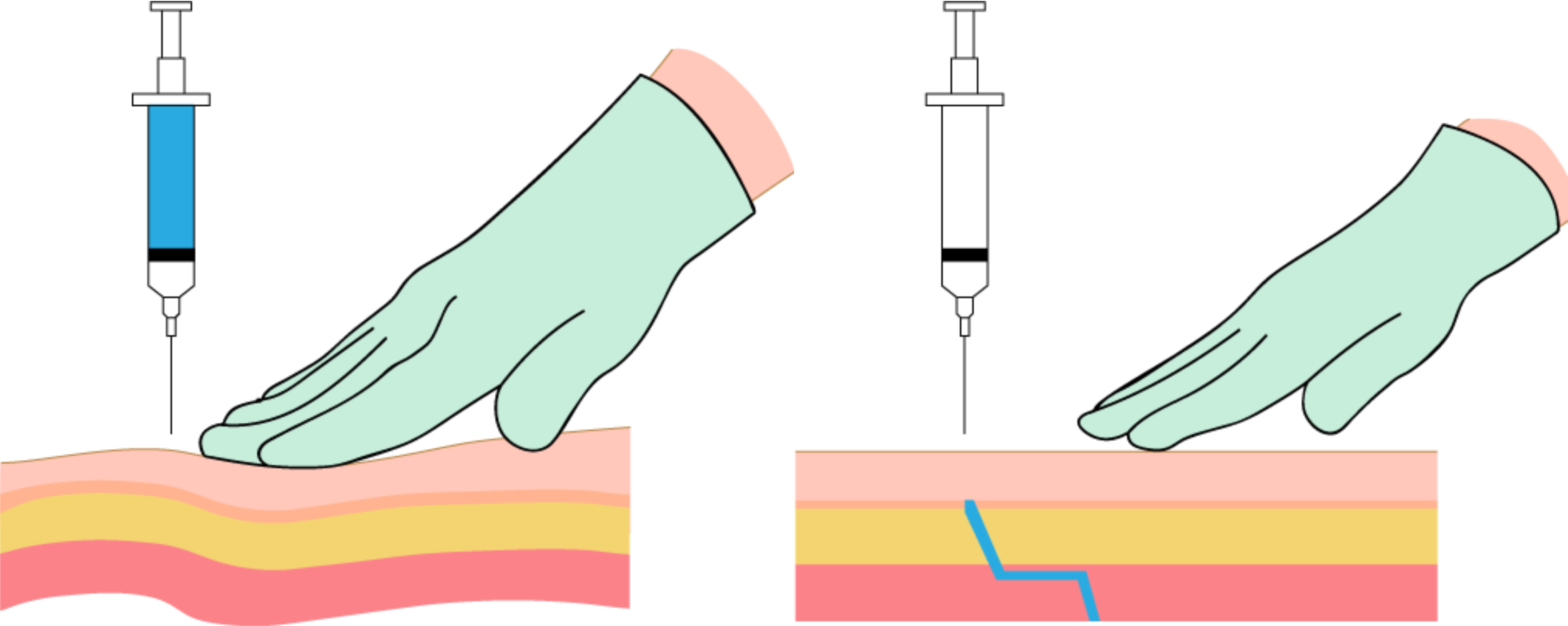 Illustration showing two parts of the Z track method