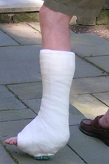Image a plaster leg cast made of calcium sulfate hemihydrate