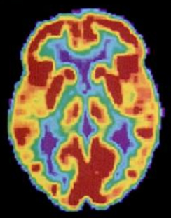 A brain scan shows different parts of the brain in different colors.